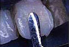 Closeup of Tooth During Bonding Process